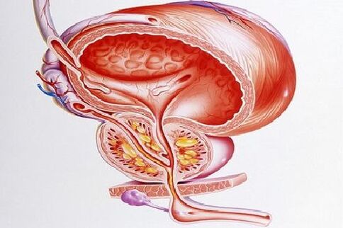 abces de prostată ca indicație pentru intervenția chirurgicală pentru prostatita