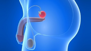 masaj de prostată pentru prevenirea prostatitei