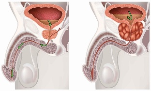tratament naturist pt adenomul de prostata prostatita o abordare integrată