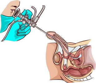 Procedura de ureteroscopie
